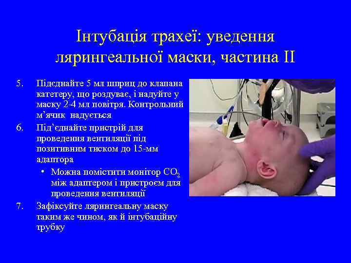 Інтубація трахеї: уведення лярингеальної маски, частина II 5. 6. 7. Підєднайте 5 мл шприц