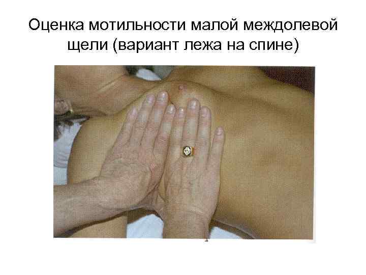 Оценка мотильности малой междолевой щели (вариант лежа на спине) 