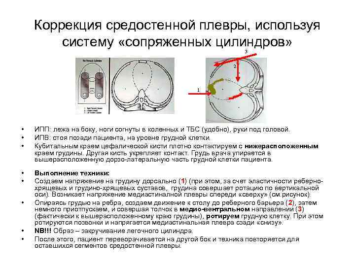 Коррекция средостенной плевры, используя систему «сопряженных цилиндров» 3 2 1 • • • ИПП: