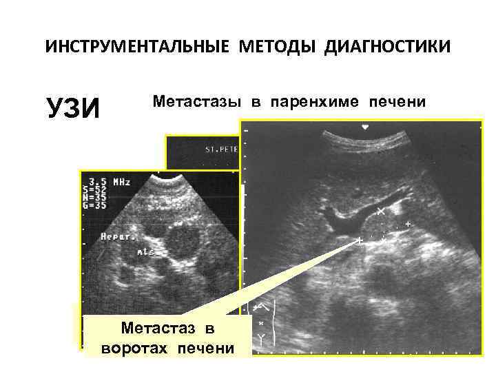 ИНСТРУМЕНТАЛЬНЫЕ МЕТОДЫ ДИАГНОСТИКИ УЗИ Метастазы в паренхиме печени УЛЬТРАЗВУКОВОЕ СКАНИРОВАНИЕ ПЕРВИЧНАЯ ОПУХОЛЬ Метастаз в