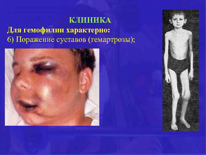 КЛИНИКА Для гемофилии характерно: 6) Поражение суставов (гемартрозы); 