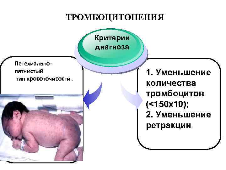 ТРОМБОЦИТОПЕНИЯ Критерии диагноза Петехиальнопятнистый тип кровоточивости. 1. Уменьшение количества тромбоцитов (<150 х10); 2. Уменьшение