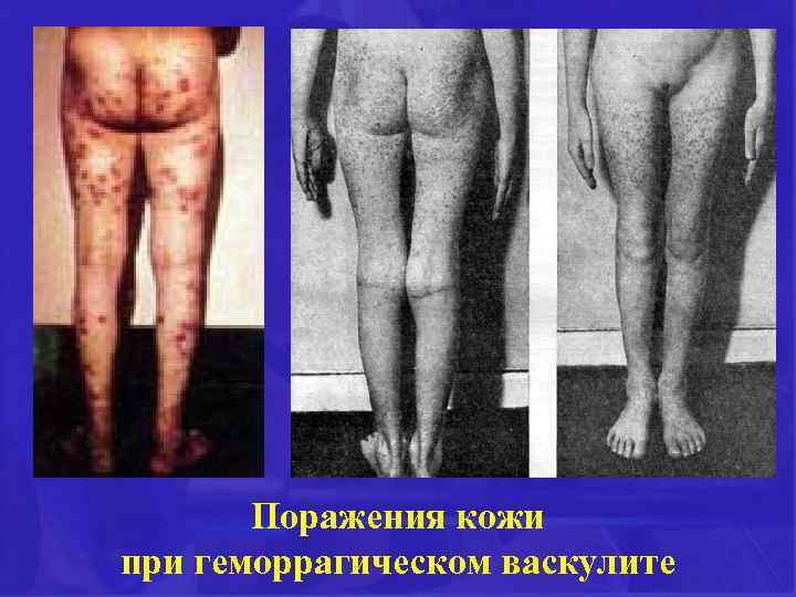 Поражения кожи при геморрагическом васкулите 