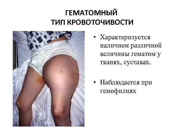 ГЕМАТОМНЫЙ ТИП КРОВОТОЧИВОСТИ • Характеризуется наличием различной величины гематом у тканях, суставах. • Наблюдается