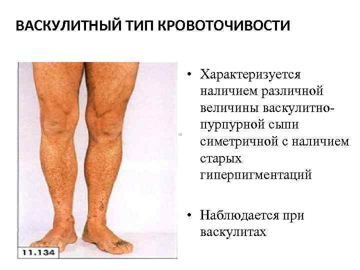 ВАСКУЛИТНЫЙ ТИП КРОВОТОЧИВОСТИ • Характеризуется наличием различной величины васкулитнопурпурной сыпи симетричной с наличием старых