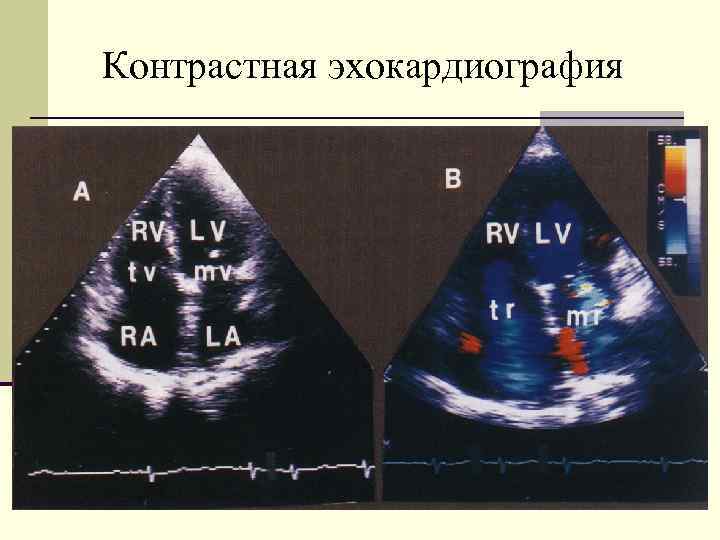 Контрастная эхокардиография 