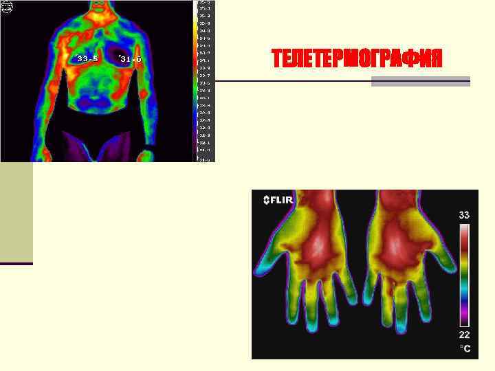 ТЕЛЕТЕРМОГРАФИЯ 