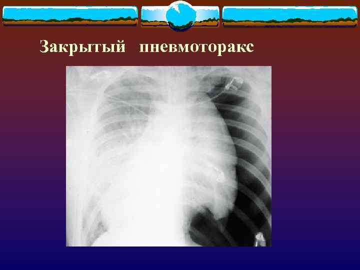 Закрытый пневмоторакс 