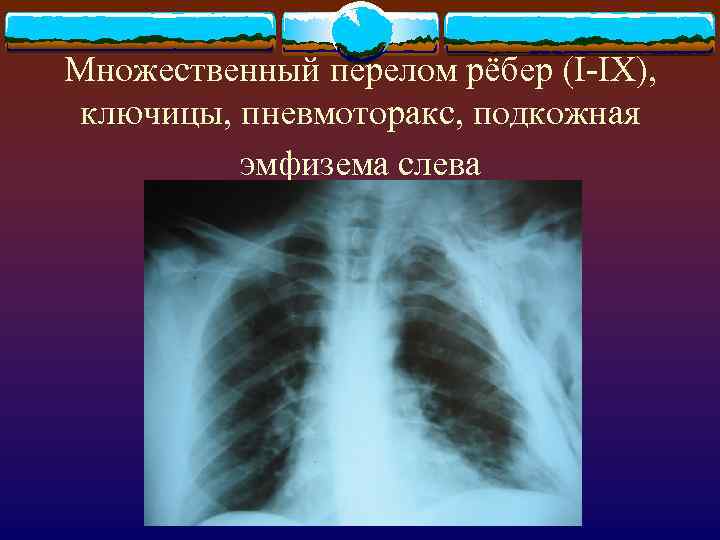 Множественный перелом рёбер (I-IX), ключицы, пневмоторакс, подкожная эмфизема слева 
