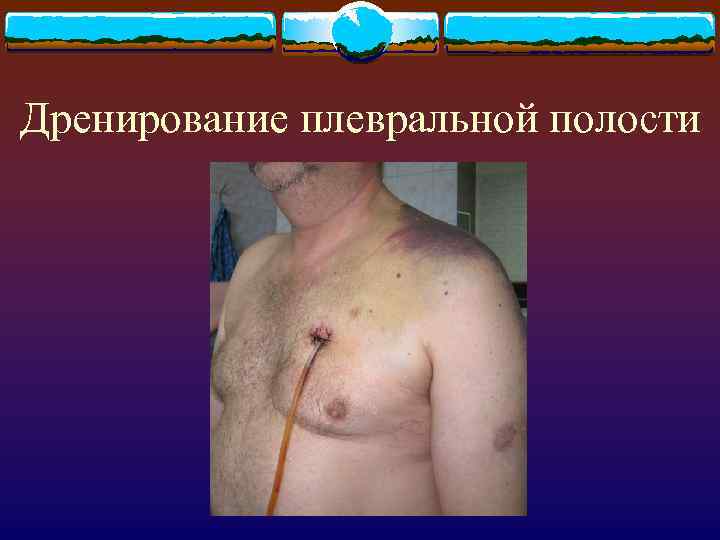 Дренирование плевральной полости 