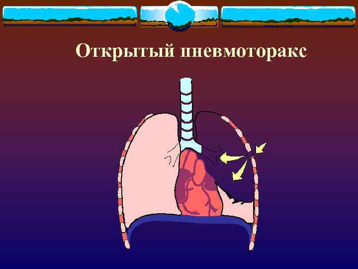 Открытый пневмоторакс 