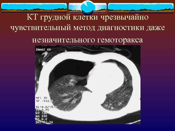 КТ грудной клетки чрезвычайно чувствительный метод диагностики даже незначительного гемоторакса 