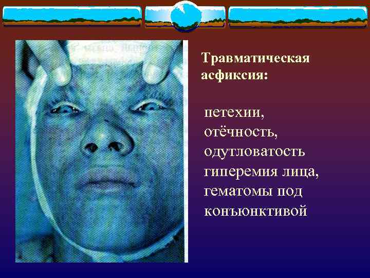 Травматическая асфиксия: петехии, отёчность, одутловатость гиперемия лица, гематомы под конъюнктивой 