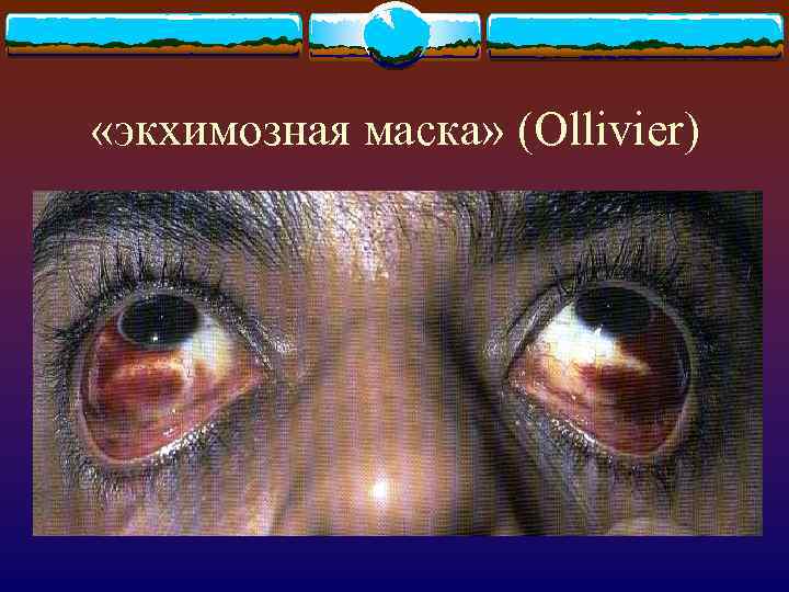  «экхимозная маска» (Ollivier) 