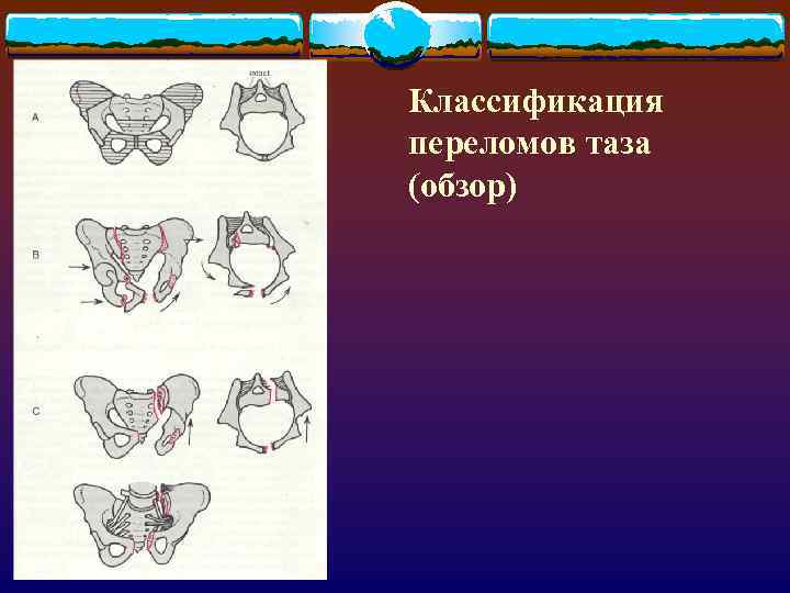 Классификация переломов таза (обзор) 