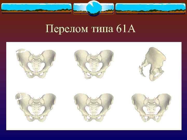 Перелом типа 61 А 