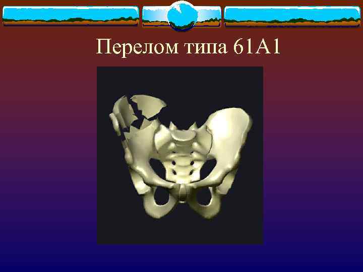 Перелом типа 61 А 1 