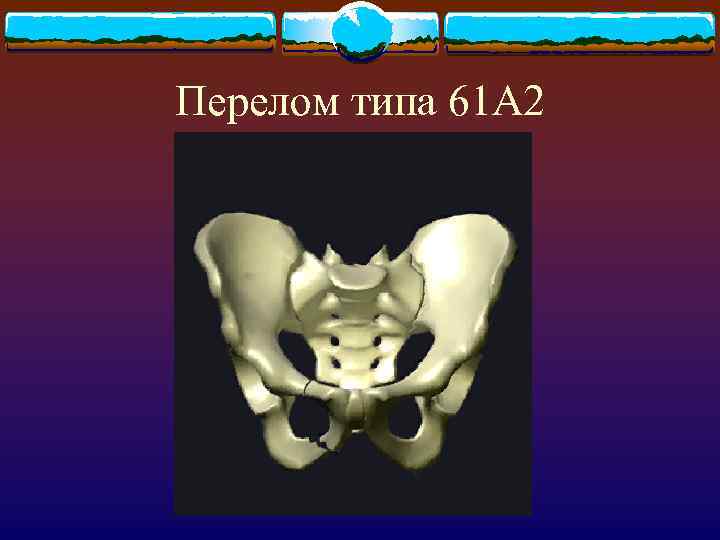 Перелом типа 61 А 2 