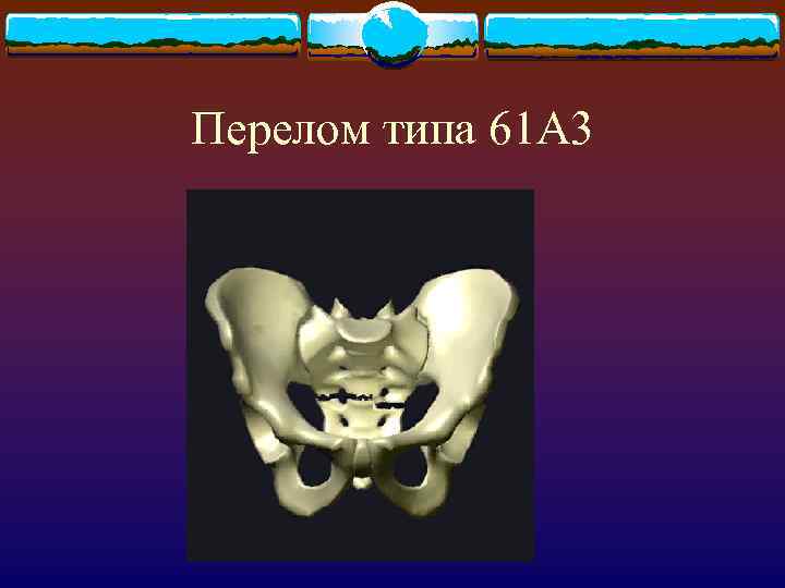 Перелом типа 61 А 3 