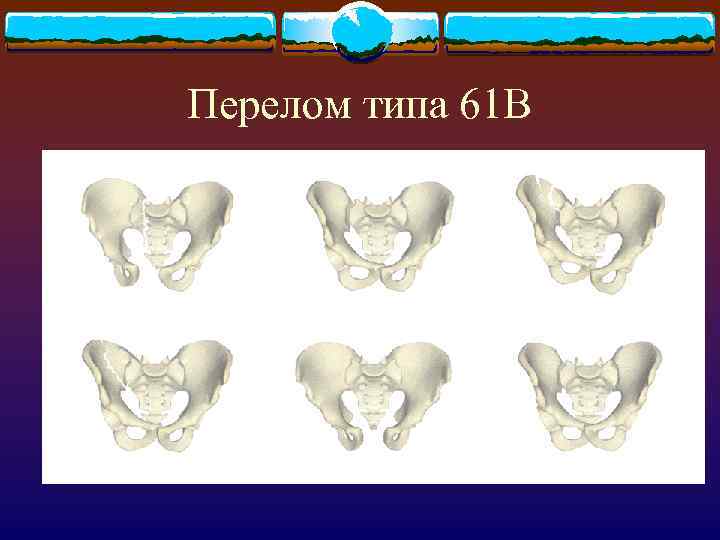 Перелом типа 61 В 