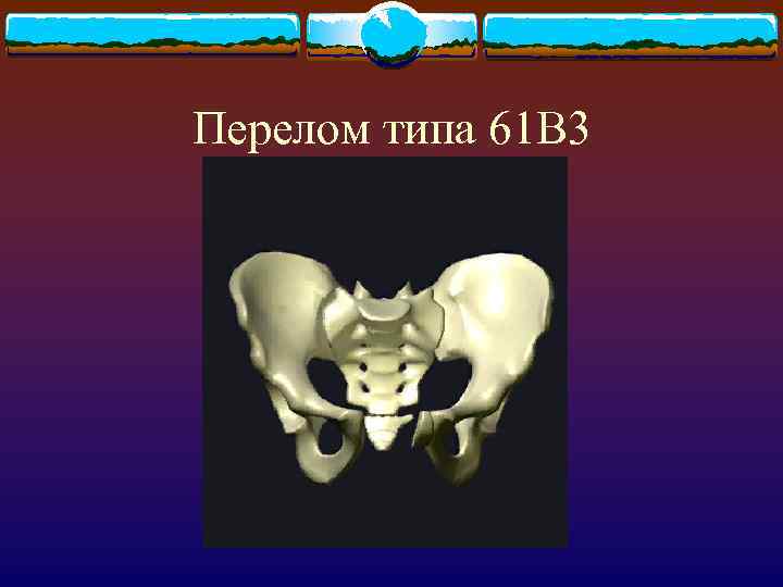 Перелом типа 61 В 3 