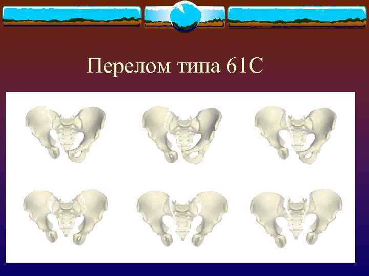 Перелом типа 61 С 