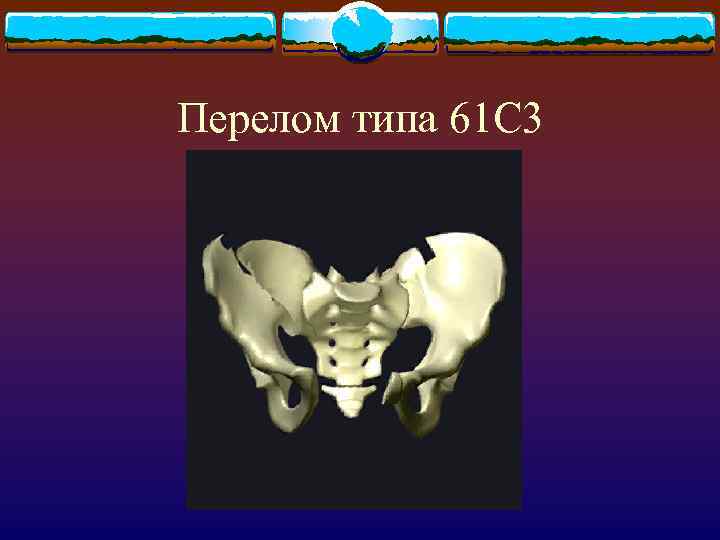 Перелом типа 61 С 3 