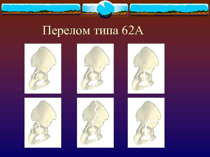 Перелом типа 62 А 