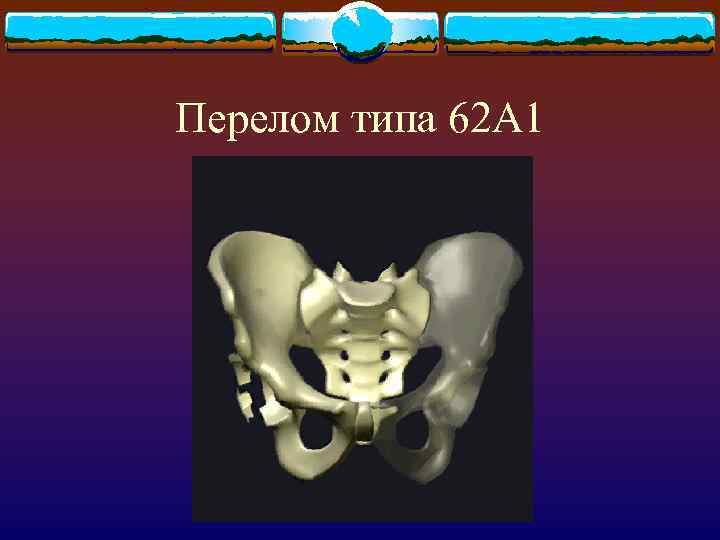 Перелом типа 62 А 1 