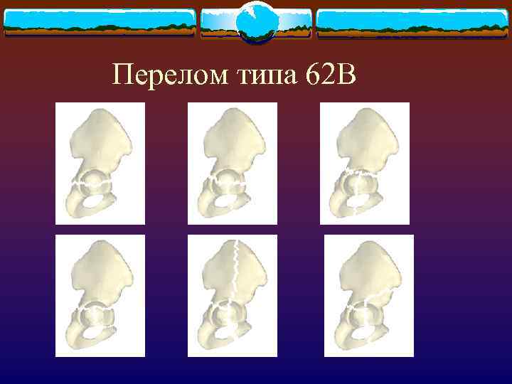 Перелом типа 62 В 