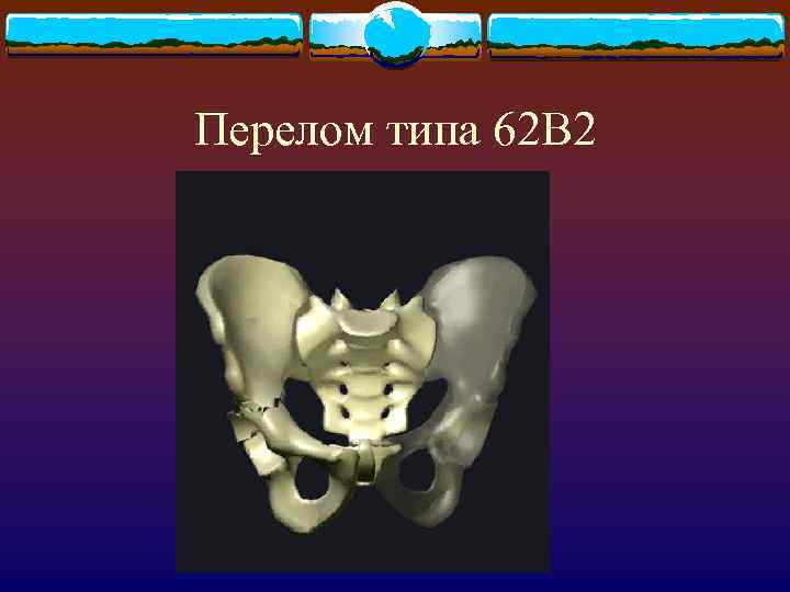 Перелом типа 62 В 2 