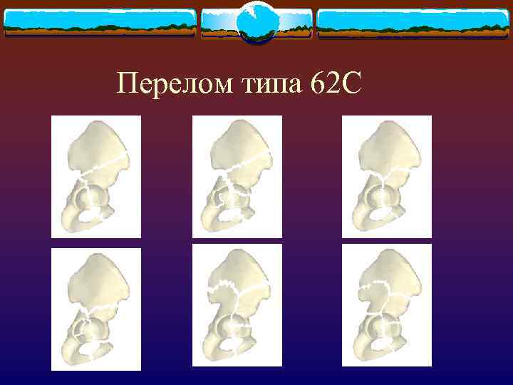 Перелом типа 62 С 