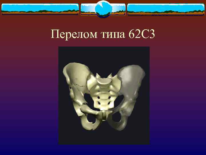 Перелом типа 62 С 3 