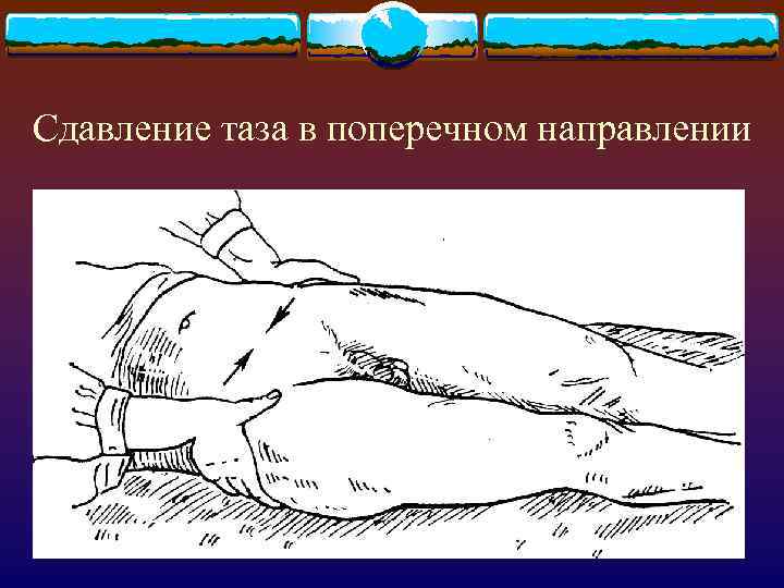 Сдавление таза в поперечном направлении 