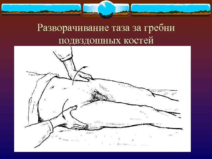 Разворачивание таза за гребни подвздошных костей 