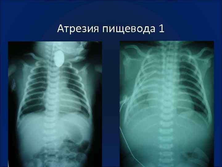 Атрезия пищевода у детей презентация