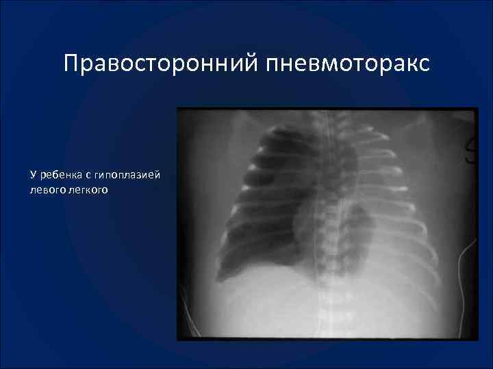 Пневмоторакс лучевая диагностика презентация