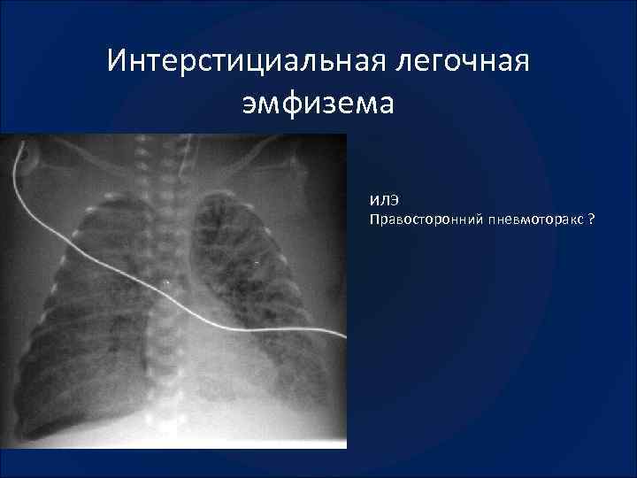 Врожденная лобарная эмфизема клиника рентгенологическая картина принципы лечения