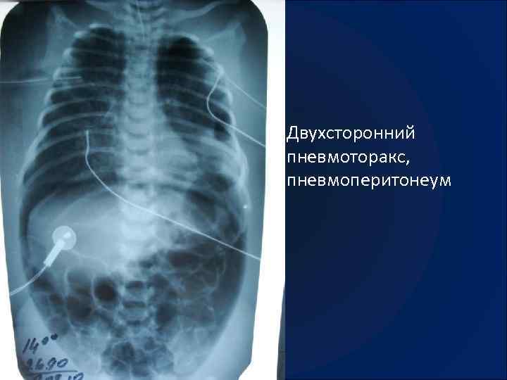 Карта смп пневмоторакс спонтанный