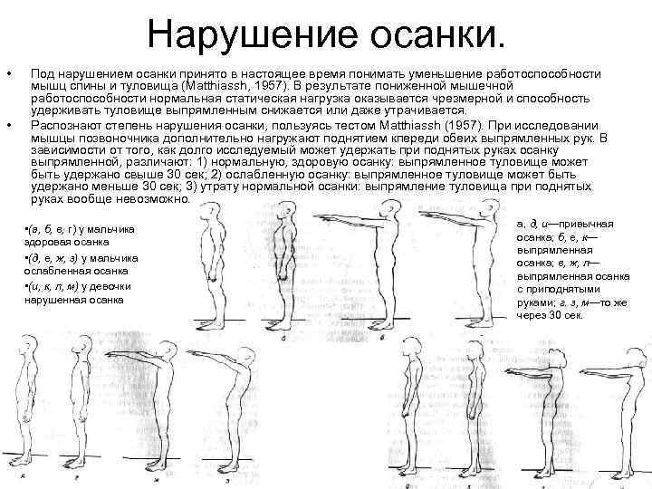 Нарушение осанки. • • Под нарушением осанки принято в настоящее время понимать уменьшение работоспособности