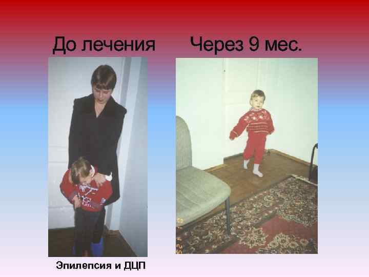 До лечения Эпилепсия и ДЦП Через 9 мес. 