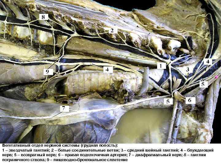 Вегетативный отдел нервной системы (грудная полость): 1 – звездчатый ганглий; 2 – белые соединительные