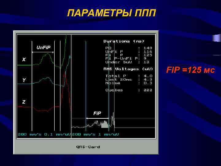 ПАРАМЕТРЫ ППП Un. Fi. P X Fi. P =125 мс Y Z Fi. P