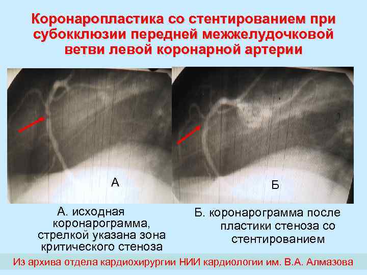 Коронаропластика со стентированием при субокклюзии передней межжелудочковой ветви левой коронарной артерии А А. исходная