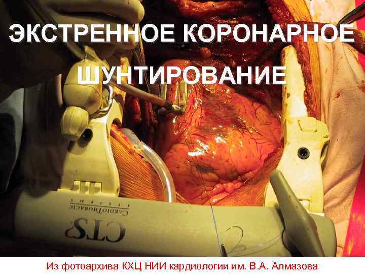 ЭКСТРЕННОЕ КОРОНАРНОЕ ШУНТИРОВАНИЕ Из фотоархива КХЦ НИИ кардиологии им. В. А. Алмазова 