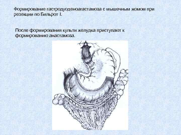 Формирование гастродуоденоагастамоза с мышечным жомом при резекции по Бильрот I. После формирования культи желудка