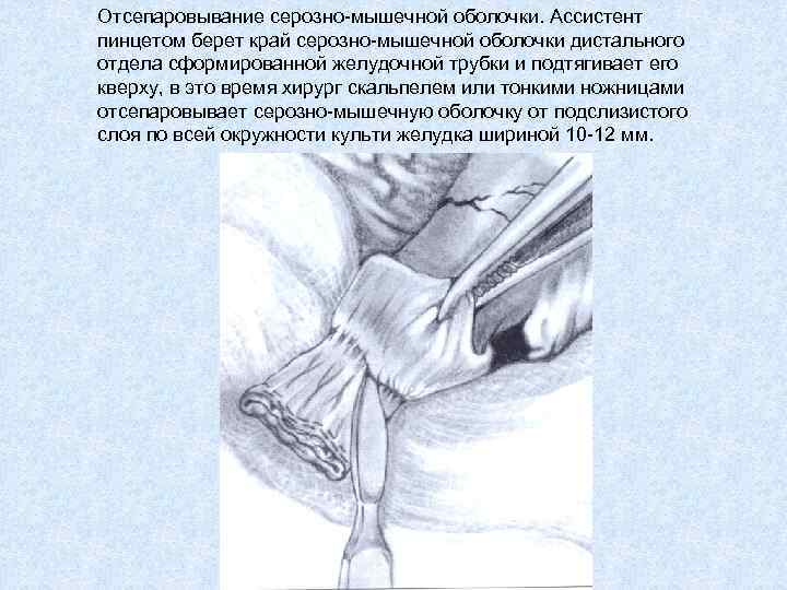 Отсепаровывание серозно-мышечной оболочки. Ассистент пинцетом берет край серозно-мышечной оболочки дистального отдела сформированной желудочной трубки