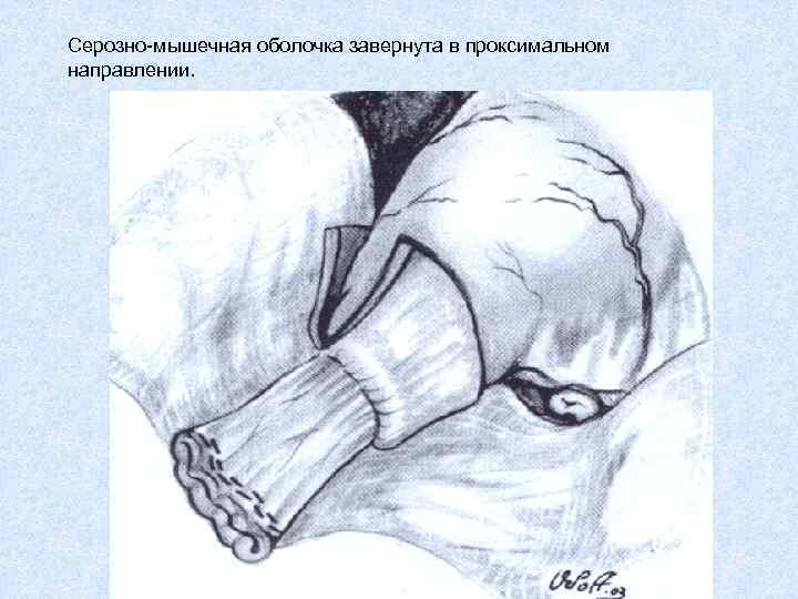 Серозно-мышечная оболочка завернута в проксимальном направлении. 