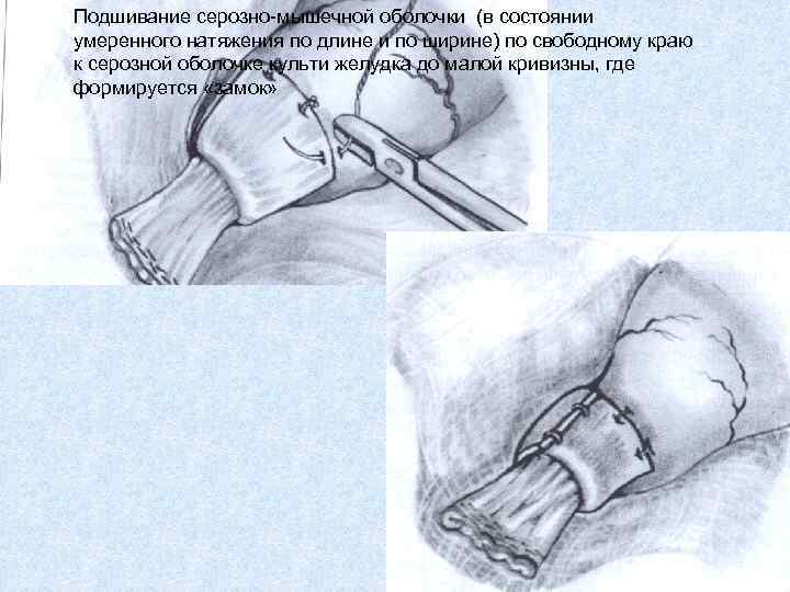 Подшивание серозно-мышечной оболочки (в состоянии умеренного натяжения по длине и по ширине) по свободному