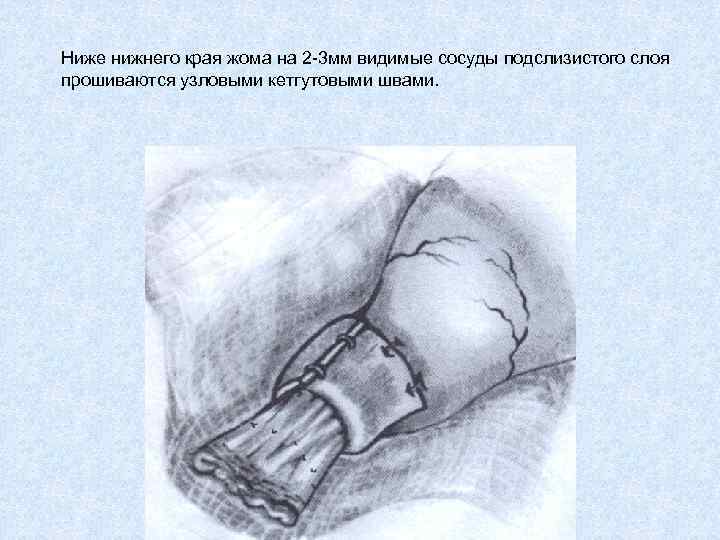 Ниже нижнего края жома на 2 -3 мм видимые сосуды подслизистого слоя прошиваются узловыми